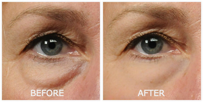 revitol eye cream results, revitol cream