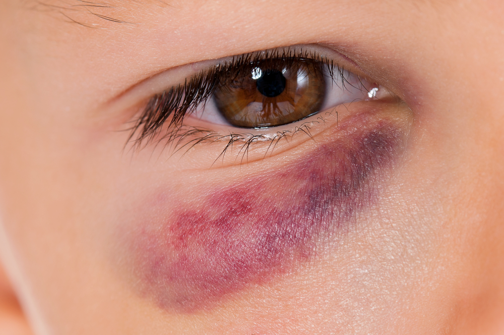 Read more about the article How to Properly Care for a Black Eye